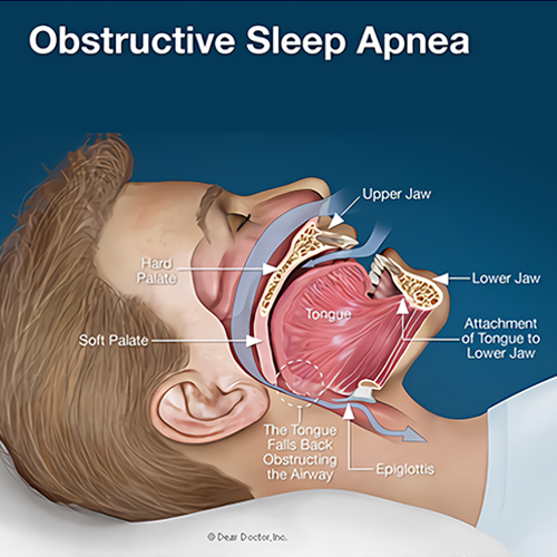 sleep apnea