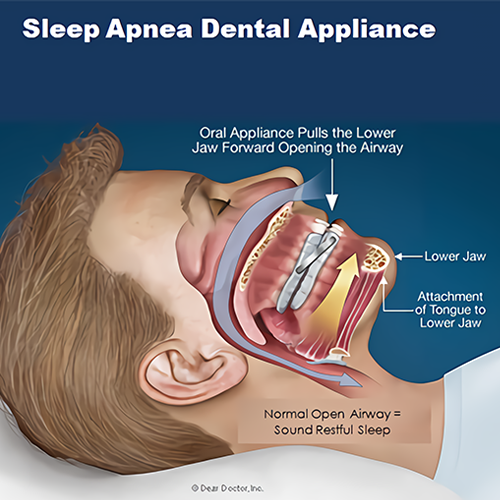 sleep apnea2